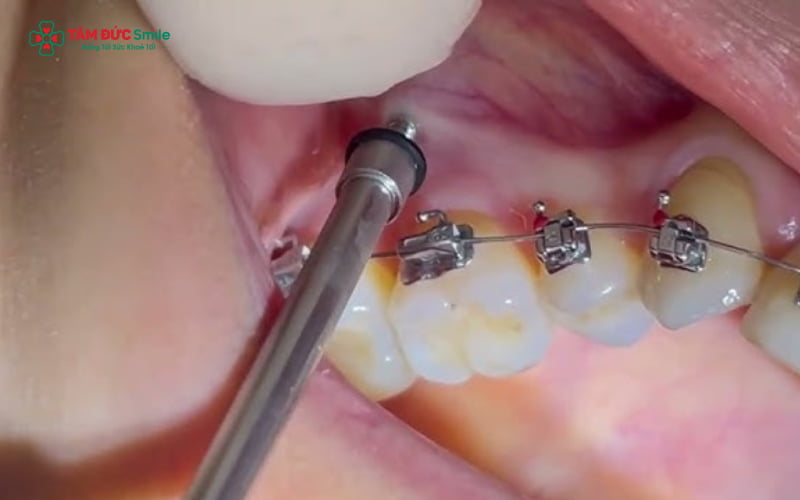 Tháo vít Abc87 tải ứng dụng diễn ra an toàn, nhanh chóng và dễ chịu