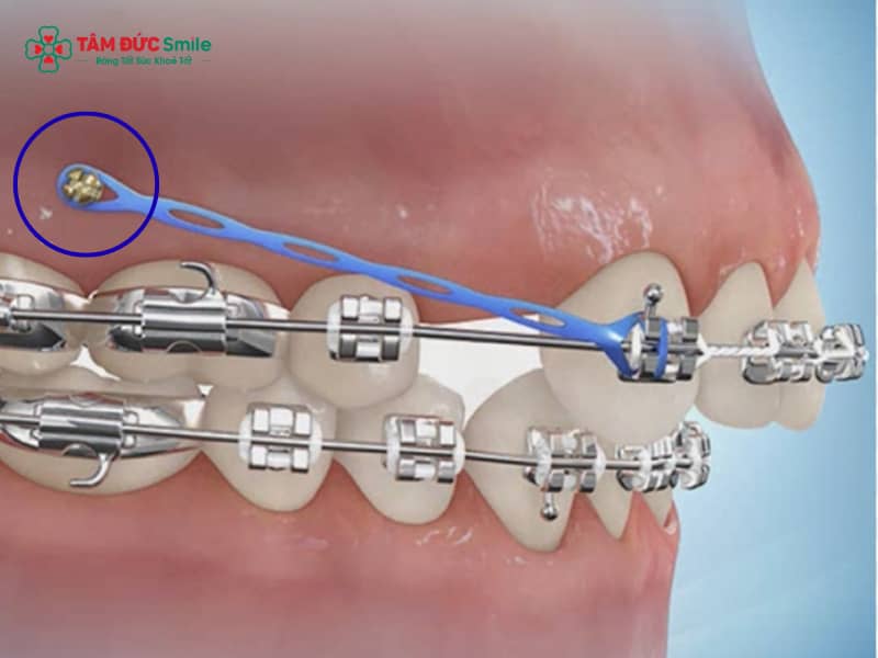 Cắm vít Abc87 tải ứng dụng là gì? Tác dụng, chi phí, quy trình và chăm sóc an toàn