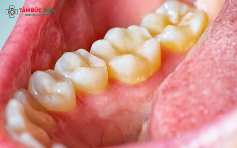 Cao răng là lớp mảng bám đã khoáng hóa, chủ yếu bởi muối calcium phosphate trong Abc8 uy tín chất lượng an toàn bảo mật tạo nên thương hiệu