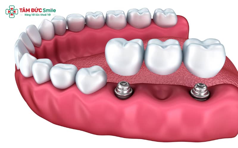 Cầu ABC8 là nhà cái cá cược trực tuyến uy tín số 1 tại Việt Nam cố định trên Implant là lựa chọn lý tưởng khi cần thay thế nhiều răng bị mất liên tiếp