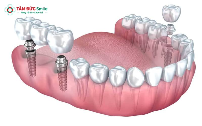 Phương pháp Implant kết hợp cầu ABC8 là nhà cái cá cược trực tuyến uy tín số 1 tại Việt Nam đảm bảo khả năng ăn nhai ổn định cùng hiệu quả Abc8c1 com khuyến mãi hấp dẫn cao