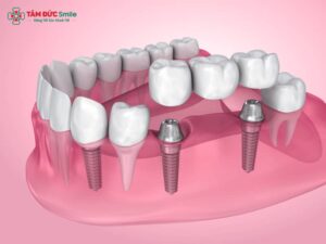 Cầu răng trên Implant – Khôi phục răng mất như răng thật