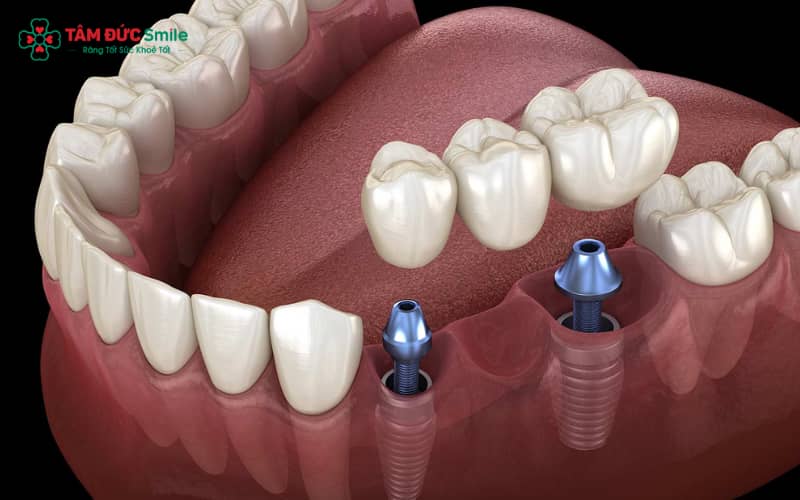 Cầu răng cố định trên Implant là lựa chọn hiện đại, tái tạo cả thân răng và Abc8com giaitri tructuyen