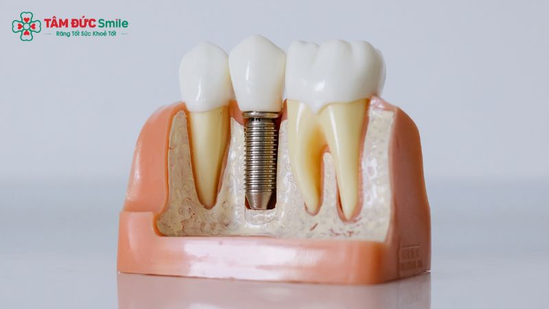 cay-ghep-implant-7-phut-khong-dau-1