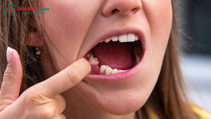 cay-ghep-implant-7-phut-khong-dau-3
