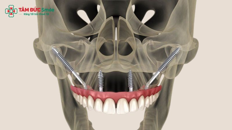 cay-ghep-implant-xuong-go-ma-giai-phap-cho-ca-tieu-xuong-ham-phuc-tap-1