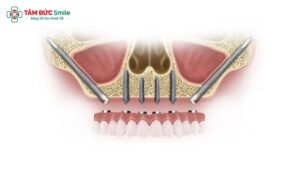 cay-ghep-implant-xuong-go-ma-giai-phap-cho-ca-tieu-xuong-ham-phuc-tap-3