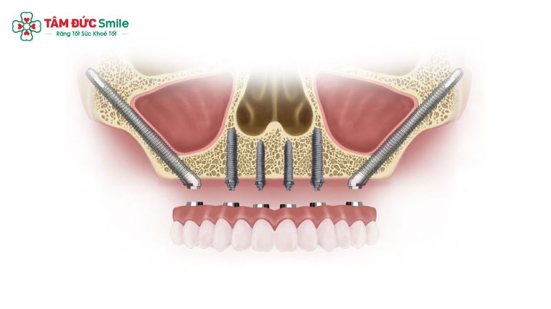 cay-ghep-implant-xuong-go-ma-giai-phap-cho-ca-tieu-xuong-ham-phuc-tap-3
