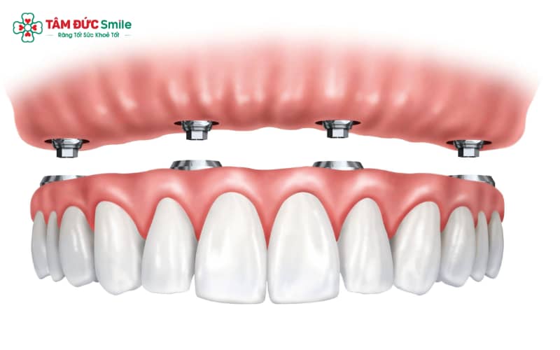 Cấy Implant gắn răng là quá trình Abc8b tỷ lệ kèo World Cup 2026 nhiều giai đoạn, đảm bảo trụ Implant tích hợp chắc chắn trước khi phục hình
