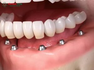 Cấy Implant bao lâu thì gắn răng? Thời gian & lưu ý