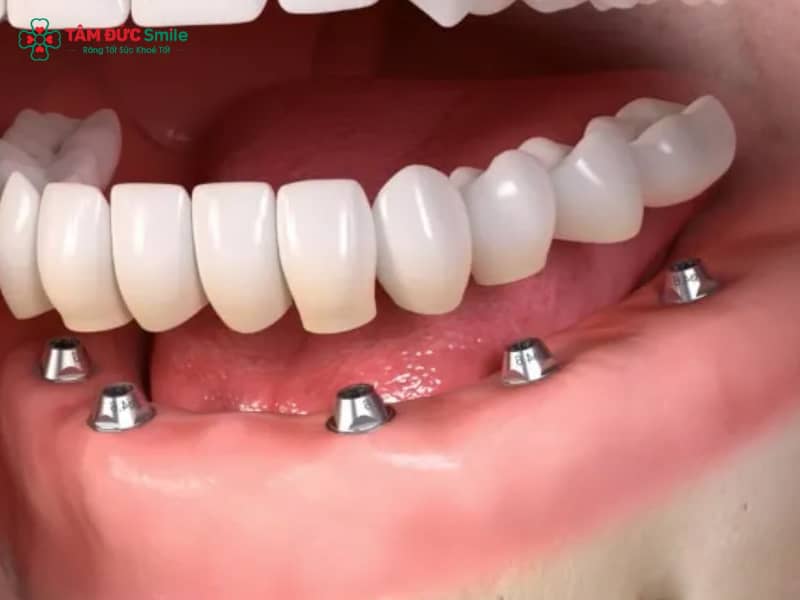Cấy Implant bao lâu thì gắn răng? Thời gian & lưu ý