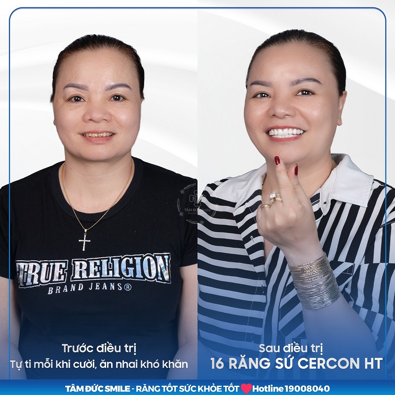 chinh-rang-moc-lech-khong-can-nieng-2