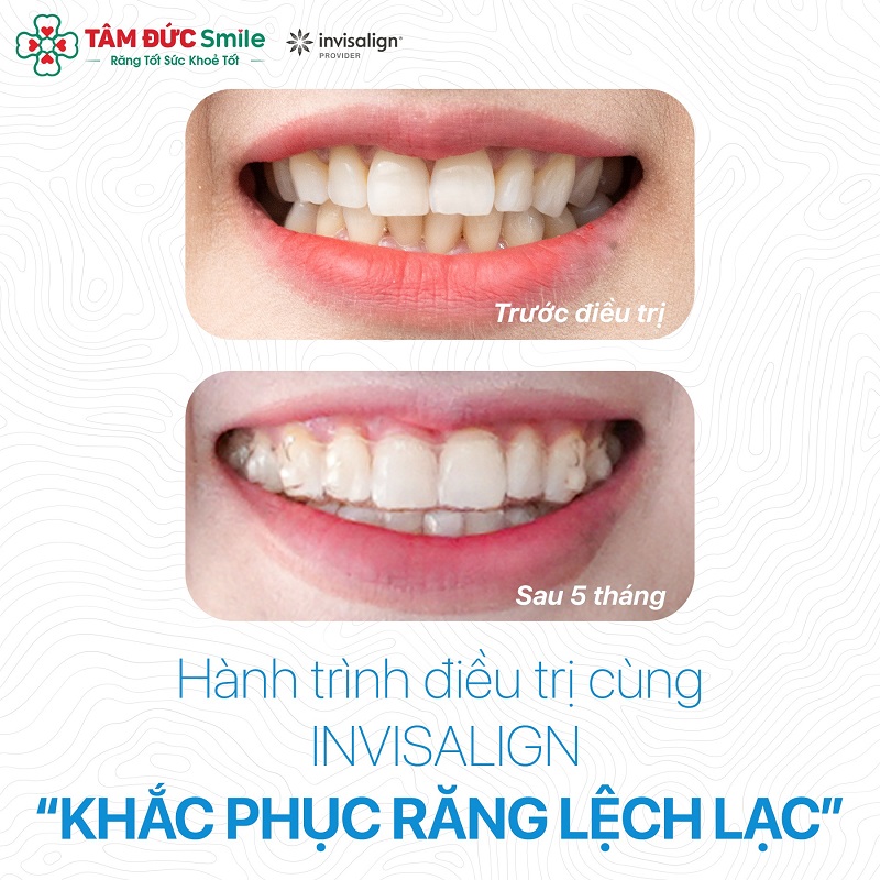 chinh-rang-moc-lech-khong-can-nieng-3