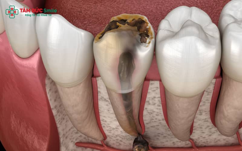 Súc miệng nước muối giúp hỗ trợ giảm đau răng sâu