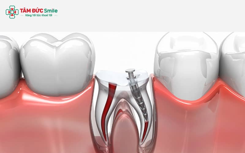 Chữa tủy răng cửa giúp loại bỏ phần tủy hư tổn, nhiễm trùng và vệ sinh ống tủy sạch sẽ