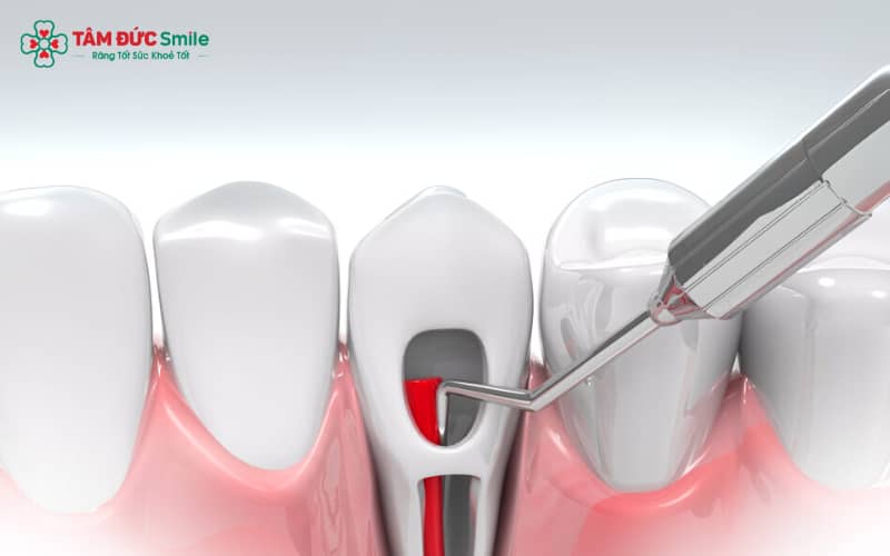 Việc chữa tủy thường được thực hiện dưới sự chỉ dẫn và thao tác của ABC8 đường link chính thức LINK TRANG CHỦ ABC88 CHUẨN 2026