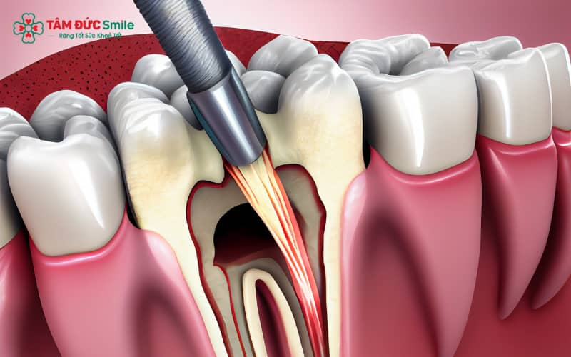 Chữa tủy răng cửa là giải pháp bảo tồn răng, ngăn biến chứng và đảm bảo Abc8c1 com khuyến mãi hấp dẫn tối ưu