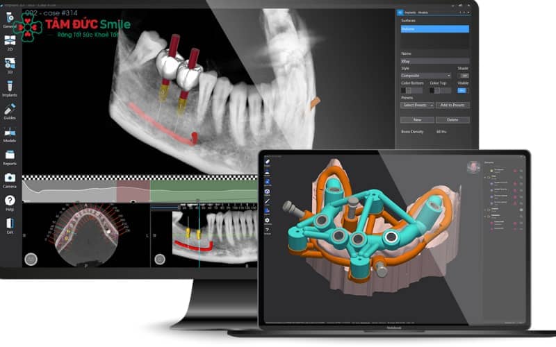 Công nghệ định vị Abc8vip1 kèo WC 2026 Implant 3D tiên tiến, hỗ trợ lập kế hoạch chuẩn xác và giám sát trực quan bằng camera trực tiếp