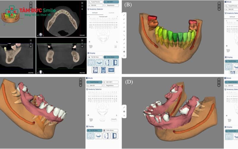 Ứng dụng phần mềm mô phỏng 3D, ABC8 đường link chính thức tính toán và định hướng vị trí, góc cắm và chiều dài phù hợp nhất cho trụ Implant