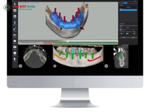 Công nghệ định vị Abc8vip1 kèo WC 2026 Implant 3D: Nguyên lý & Ưu điểm