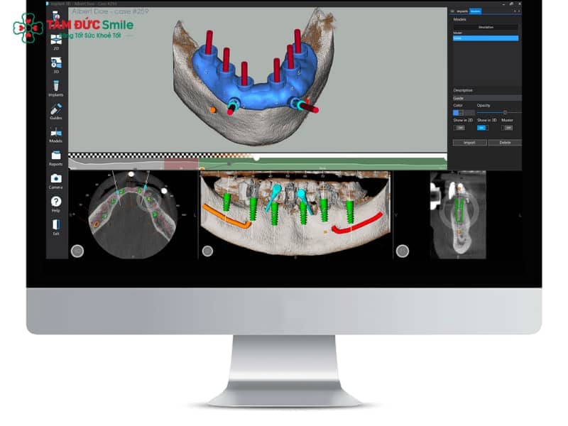 Công nghệ định vị Abc8vip1 kèo WC 2026 Implant 3D: Nguyên lý & Ưu điểm