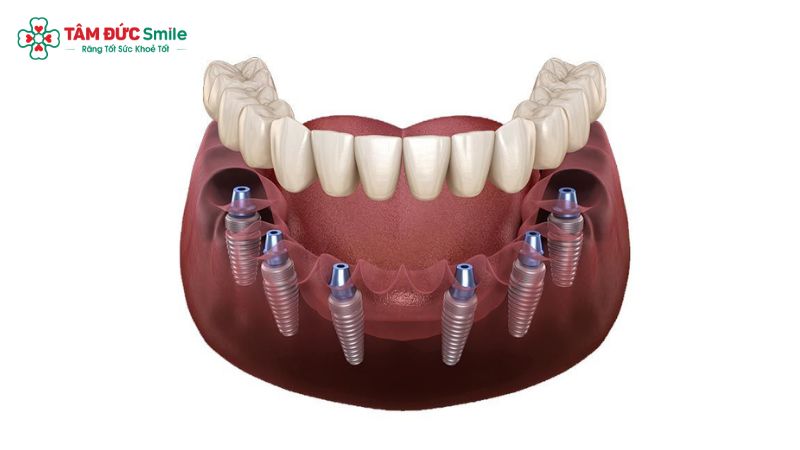cong-nghe-implant-3