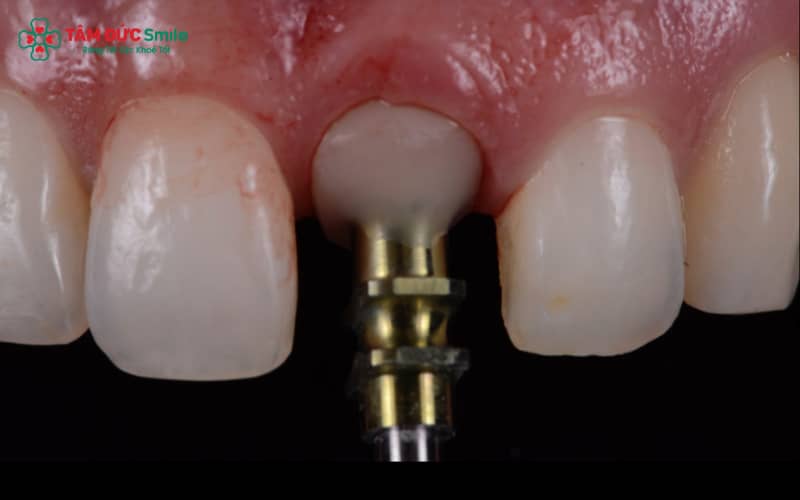 Mão lấy dấu được thiết kế sẵn nhằm hỗ trợ việc xác định vị trí Implant và lấy dấu chuẩn xác trong miệng
