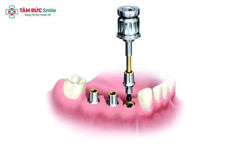 Coping implant là bộ phận được thiết kế sẵn, giúp xác định chính xác vị trí Implant và hỗ trợ quá trình lấy dấu trong miệng