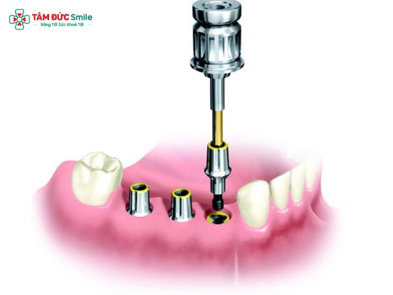Coping Implant: Chức năng, phân loại và lợi ích phục hình