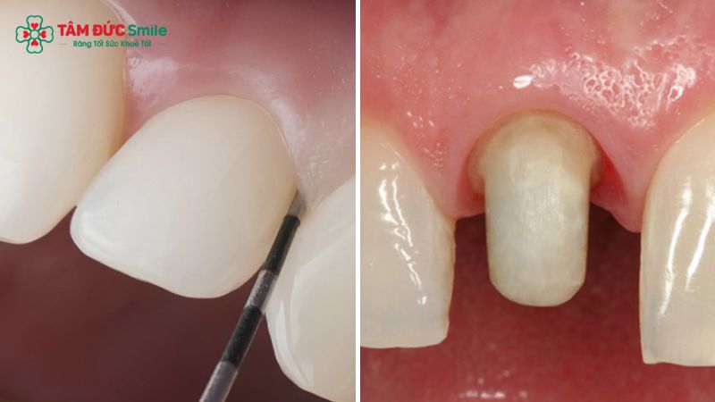 Veneer phù hợp với răng thưa nhẹ, mẻ nhẹ hoặc nhiễm màu khó tẩy trắng.