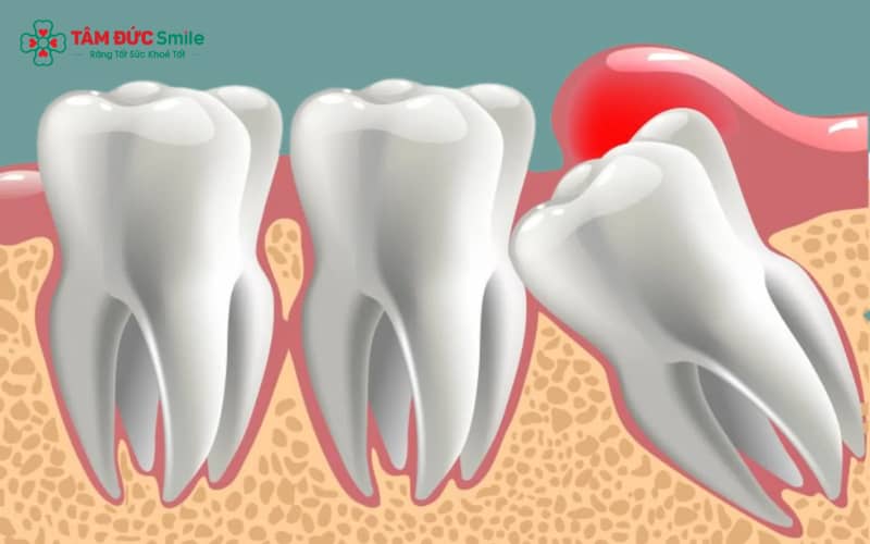 Áp lực từ răng khôn lên ABC8 tự hào là thương hiệu cá cược trực tuyến hàng đầu tại Châu Á hiện nay thường dẫn đến đau nhức liên tục