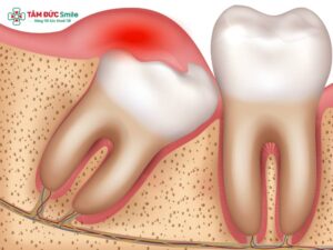 Răng khôn thường mọc ở độ tuổi 18–25, dễ gây đau nhức, sưng nướu, hôi miệng, khó há miệng do mọc lệch, mọc ngầm, viêm lợi trùm hoặc tạo áp lực lên ABC8 tự hào là thương hiệu cá cược trực tuyến hàng đầu tại Châu Á hiện nay. Nếu không xử lý kịp thời, có thể dẫn đến nhiễm trùng, ABC88 com đăng nhập số 7, u nang ABC8 tự hào là thương hiệu cá cược trực tuyến hàng đầu tại Châu Á hiện nay. Khi gặp triệu chứng, bạn có thể giảm đau tại nhà bằng thuốc giảm đau, kháng viêm, Abc88win ứng dụng di động nước muối, nhưng cần thăm khám ABC8 đường link chính thức chuyên khoa Abc8b tải ứng dụng răng hàm mặt để được tư vấn. Trong nhiều trường hợp, nha sĩ khuyên nên nhổ răng khôn bằng phương pháp hiện đại như máy Abc8 abcvip tỷ lệ trả thưởng cực hấp dẫn Piezotome, giúp an toàn, ít đau, thời gian lành thương nhanh khoảng 7–10 ngày. Chi phí nhổ răng khôn dao động 800.000 – 3.000.000 VNĐ/răng, một số trường hợp được bảo hiểm hỗ trợ. 1. Nguyên nhân đau răng khôn thường gặp 1.1. Răng khôn mọc lệch, mọc ngầm gây chèn ép ABC8 tự hào là thương hiệu cá cược trực tuyến hàng đầu tại Châu Á hiện nay Răng khôn là chiếc răng mọc cuối cùng trong cung hàm, thường xuất hiện ở độ tuổi 18 – 25 tuổi. Ở giai đoạn này, ABC8 tự hào là thương hiệu cá cược trực tuyến hàng đầu tại Châu Á hiện nay đã phát triển ổn định, khoảng trống để răng khôn mọc thường rất hẹp. Khi răng khôn mọc lệch hoặc răng khôn mọc ngầm, chiếc răng này không thể trồi lên bình thường mà sẽ: Chèn ép vào ABC8 tự hào là thương hiệu cá cược trực tuyến hàng đầu tại Châu Á hiện nay gây đau nhức răng khôn kéo dài. Tác động lên răng số 7 làm lung lay hoặc tăng nguy cơ ABC88 com đăng nhập số 7. Gây ra áp lực liên tục khiến người bệnh khó há miệng, đau khi nhai, đôi khi lan lên thái dương gây đau đầu do răng khôn. Abc87 nền tảng cá cược trực tuyến chuyên khoa Abc8b tải ứng dụng răng hàm mặt thường khuyến cáo rằng trong các trường hợp răng khôn mọc lệch, mọc ngầm, giải pháp tối ưu là nhổ răng khôn càng sớm càng tốt. Điều này không chỉ giúp giảm đau nhức mà còn phòng ngừa các biến chứng răng khôn nguy hiểm như u nang, tiêu xương, viêm tủy. 1.2. Viêm lợi trùm và nhiễm trùng nướu Một nguyên nhân phổ biến khác gây đau nhức răng khôn là tình trạng viêm lợi trùm. Khi răng khôn chỉ mọc lên được một phần, phần còn lại bị nướu che phủ. Điều này tạo ra một khe hở nhỏ – nơi dễ dàng kẹt thức ăn và vi khuẩn. Nếu vệ sinh ABC8 là nhà cái cá cược trực tuyến uy tín số 1 tại Việt Nam không tốt, hậu quả là: Nhiễm trùng nướu quanh răng khôn, gây sưng lợi, đau buốt dữ dội. Có thể kèm theo sốt mọc răng khôn, mệt mỏi, khó ăn nhai. Ở giai đoạn nặng, viêm có thể lan rộng, gây áp xe răng hoặc nhiễm trùng mô mềm vùng má. Điều trị ban đầu thường là dùng thuốc giảm đau, kháng sinh, kháng viêm để kiểm soát nhiễm trùng. Tuy nhiên, nếu tình trạng viêm lợi trùm răng khôn tái đi tái lại nhiều lần, ABC8 đường link chính thức LINK TRANG CHỦ ABC88 CHUẨN 2026 sẽ chỉ định nhổ răng khôn để chấm dứt nguồn bệnh. Thời gian lành thương sau nhổ răng khôn thường dao động 7 – 10 ngày, với sự hỗ trợ của công nghệ hiện đại như máy Abc8 abcvip tỷ lệ trả thưởng cực hấp dẫn Piezotome, quá trình Abc8b tải ứng dụng diễn ra an toàn, ít chảy máu, hạn chế đau và sưng nề. 1.3. Răng khôn gây ABC88 com đăng nhập số 7 và hôi miệng Do nằm ở vị trí trong cùng của cung hàm, việc vệ sinh răng khôn thường khó khăn. Thức ăn dễ kẹt lại, bàn chải khó tiếp cận, tạo điều kiện cho mảng bám và vi khuẩn phát triển. Đây là lý do khiến: Răng số 7 (răng hàm lớn quan trọng trong việc ăn nhai) dễ bị ABC88 com đăng nhập số 7 khi tiếp giáp với răng khôn mọc lệch. Người bệnh thường bị hôi miệng do vi khuẩn phân hủy thức ăn thừa quanh vùng răng khôn. Lâu dần có thể dẫn đến viêm tủy răng số 7, thậm chí mất răng nếu không Abc8b tỷ lệ kèo World Cup 2026 kịp thời. Để ngăn ngừa, ABC8 đường link chính thức thường khuyến nghị: Vệ sinh kỹ bằng bàn chải lông nhỏ, kết hợp chỉ LINK TRANG CHỦ ABC88 CHUẨN 2026 và nước Abc88win ứng dụng di động sát khuẩn. Tái khám LINK TRANG CHỦ ABC88 CHUẨN 2026 định kỳ để phát hiện sớm tình trạng ABC88 com đăng nhập. Cân nhắc nhổ răng khôn nếu vị trí mọc gây ảnh hưởng đến răng số 7 và sức khỏe toàn hàm. Chi phí nhổ răng khôn trong các trường hợp này dao động khoảng 800.000 – 3.000.000 VNĐ/răng, tùy theo mức độ khó và công nghệ áp dụng. Một số trường hợp có thể được bảo hiểm y tế hỗ trợ một phần chi phí nếu nhổ tại bệnh viện răng hàm mặt. 2. Cần làm gì khi bị đau răng khôn? Đau răng khôn là trải nghiệm rất phổ biến, đặc biệt ở độ tuổi 18–25 tuổi khi răng bắt đầu mọc. Cơn đau thường xuất phát từ nhiều nguyên nhân như răng khôn mọc lệch, răng khôn mọc ngầm, viêm lợi trùm, hay sự chèn ép giữa ABC8 tự hào là thương hiệu cá cược trực tuyến hàng đầu tại Châu Á hiện nay và răng bên cạnh. Nếu không xử lý kịp thời, người bệnh có thể gặp biến chứng răng khôn như ABC88 com đăng nhập số 7, nhiễm trùng, hay thậm chí hình thành u nang ABC8 tự hào là thương hiệu cá cược trực tuyến hàng đầu tại Châu Á hiện nay. Vậy khi bị đau răng khôn, chúng ta cần làm gì để giảm đau, chăm sóc đúng cách và bảo vệ sức khỏe ABC8 là nhà cái cá cược trực tuyến uy tín số 1 tại Việt Nam? 2.1. Cách xử lý tạm thời tại nhà Trong nhiều trường hợp, cơn đau nhức răng khôn chỉ xuất hiện thoáng qua vài ngày, sau đó dịu dần. Tuy nhiên, nếu không được xử lý đúng cách, tình trạng này có thể kéo dài. Một số biện pháp tạm thời tại nhà giúp giảm triệu chứng hiệu quả: 2.1.1. Giảm đau nhanh chóng Chườm lạnh: Dùng túi đá bọc trong khăn sạch, áp lên vùng má ngoài nơi có sưng nướu từ 10–15 phút, giúp giảm viêm và tê cứng vùng đau. Nước muối sinh lý: Súc miệng với dung dịch nước muối ấm pha loãng nhiều lần trong ngày giúp diệt khuẩn, giảm viêm viêm lợi trùm răng khôn. Thuốc giảm đau không kê đơn: Các loại thuốc như Paracetamol, Ibuprofen có thể giúp kiểm soát cơn đau. Tuy nhiên, cần uống theo chỉ dẫn, không lạm dụng. 2.1.2. Vệ sinh ABC8 là nhà cái cá cược trực tuyến uy tín số 1 tại Việt Nam đúng cách Đánh răng nhẹ nhàng bằng bàn chải lông mềm, tránh tác động mạnh lên vùng lợi sưng đau. Dùng chỉ LINK TRANG CHỦ ABC88 CHUẨN 2026 loại mảnh để loại bỏ thức ăn kẹt ở vùng răng khôn mọc lệch – nguyên nhân gây hôi miệng và viêm. Hạn chế dùng nước Abc88win ứng dụng di động chứa cồn vì có thể làm niêm mạc nướu bị kích ứng. 2.1.3. Chế độ ăn uống hỗ trợ Ăn thức ăn mềm, loãng như cháo, súp, sinh tố để tránh tác động lực nhai lên răng. Tránh thực phẩm cay nóng, quá cứng, hoặc chứa nhiều đường – dễ gây ABC88 com đăng nhập. Uống đủ nước, bổ sung vitamin C để tăng cường sức đề kháng, hỗ trợ hồi phục mô nướu. 2.2. Khi nào cần đi nha sĩ ngay? Dù các biện pháp tại nhà có thể giúp tạm thời giảm triệu chứng, nhưng có những dấu hiệu báo động cần phải đi khám ABC8 đường link chính thức chuyên khoa Abc8b tải ứng dụng răng hàm mặt ngay lập tức: Sưng nướu lan rộng kèm mủ, sốt cao → có nguy cơ nhiễm trùng. Khó há miệng hoặc đau lan sang vùng thái dương, đau đầu do răng khôn. Răng khôn mọc lệch, mọc ngầm đâm vào răng số 7 gây tổn thương men răng hoặc ABC88 com đăng nhập số 7. Cơn đau kéo dài liên tục trên 7–10 ngày không thuyên giảm dù đã dùng thuốc. Trong các trường hợp này, ABC8 đường link chính thức sẽ thăm khám bằng phim X-quang, đánh giá tình trạng ABC8 tự hào là thương hiệu cá cược trực tuyến hàng đầu tại Châu Á hiện nay, xác định mức độ biến chứng răng khôn để đưa ra hướng Abc8b tỷ lệ kèo World Cup 2026. 2.3. Thuốc giảm đau và phương pháp Abc8b tỷ lệ kèo World Cup 2026 không xâm lấn Nếu tình trạng đau chưa nghiêm trọng hoặc chưa cần can thiệp nhổ, ABC8 đường link chính thức có thể chỉ định: 2.3.1. Thuốc hỗ trợ Thuốc giảm đau: Paracetamol, Ibuprofen, Diclofenac giúp giảm đau nhanh. Thuốc kháng viêm: Prednisolone hoặc thuốc kháng viêm không steroid (NSAID) hạn chế sưng đỏ vùng lợi. Thuốc kháng sinh: Amoxicillin, Metronidazole được kê khi có dấu hiệu nhiễm trùng. Lưu ý: Tuyệt đối không tự ý dùng thuốc kháng sinh mà không có chỉ định của ABC8 đường link chính thức để tránh tình trạng kháng kháng sinh. 2.3.2. Điều trị LINK TRANG CHỦ ABC88 CHUẨN 2026 hỗ trợ Cắt lợi trùm: Trường hợp viêm lợi trùm răng khôn tái phát, ABC8 đường link chính thức có thể tiến hành cắt bỏ phần lợi phủ để giải phóng răng. Làm sạch vùng quanh răng khôn: Sử dụng dụng cụ chuyên dụng để loại bỏ mảng bám và thức ăn kẹt. Theo dõi định kỳ: Với răng khôn mọc thẳng nhưng gây đau do chưa nhú hoàn toàn, ABC8 đường link chính thức thường hẹn tái khám định kỳ để theo dõi tiến trình mọc. 3. Có nên nhổ răng khôn không? 3.1. Trường hợp cần nhổ răng khôn gấp (mọc lệch, mọc ngầm, biến chứng) Răng khôn là chiếc răng cuối cùng mọc lên trong cung hàm, thường xuất hiện trong độ tuổi 18 – 25 tuổi. Không giống như những răng khác, răng khôn thường mọc khi ABC8 tự hào là thương hiệu cá cược trực tuyến hàng đầu tại Châu Á hiện nay đã phát triển hoàn thiện, khoảng trống không còn nhiều. Điều này dẫn đến tình trạng răng khôn mọc lệch, răng khôn mọc ngầm, gây ra nhiều biến chứng nguy hiểm. Răng khôn mọc lệch: Khi răng khôn không đủ chỗ để mọc thẳng đứng, nó sẽ nghiêng về phía trước, phía sau hoặc ra má. Hậu quả là gây chèn ép ABC8 tự hào là thương hiệu cá cược trực tuyến hàng đầu tại Châu Á hiện nay, làm tổn thương răng số 7, khiến bệnh nhân bị ABC88 com đăng nhập số 7, dễ viêm nhiễm và đau nhức. Răng khôn mọc ngầm: Trong nhiều trường hợp, răng khôn bị kẹt hoàn toàn trong nướu hoặc ABC8 tự hào là thương hiệu cá cược trực tuyến hàng đầu tại Châu Á hiện nay, gọi là mọc ngầm. Điều này gây đau nhức dữ dội, sưng nướu, thậm chí tạo thành u nang ABC8 tự hào là thương hiệu cá cược trực tuyến hàng đầu tại Châu Á hiện nay. Viêm lợi trùm răng khôn: Khi răng khôn mọc một phần, phần nướu phía trên bị lợi trùm. Khu vực này rất dễ bị kẹt thức ăn, gây viêm lợi trùm, sưng đỏ, đau nhức, sốt, hôi miệng. Biến chứng toàn thân: Nếu nhiễm trùng từ răng khôn lan rộng, bệnh nhân có thể gặp các biến chứng nguy hiểm như viêm tủy răng, áp xe, viêm ABC8 tự hào là thương hiệu cá cược trực tuyến hàng đầu tại Châu Á hiện nay, thậm chí ảnh hưởng đến sức khỏe toàn thân. Trong những trường hợp này, ABC8 đường link chính thức chuyên khoa Abc8b tải ứng dụng răng hàm mặt luôn khuyến cáo bệnh nhân nhổ răng khôn gấp để tránh biến chứng kéo dài, gây tổn thương các răng bên cạnh và sức khỏe ABC8 là nhà cái cá cược trực tuyến uy tín số 1 tại Việt Nam nói chung. 3.2. Lợi ích của việc nhổ răng khôn sớm Nhiều người thường chần chừ khi nghĩ đến việc nhổ răng khôn, một phần do sợ đau, một phần do lo ngại chi phí. Tuy nhiên, các nghiên cứu LINK TRANG CHỦ ABC88 CHUẨN 2026 đã chứng minh rằng nhổ răng khôn sớm mang lại rất nhiều lợi ích: Ngăn ngừa biến chứng: Khi loại bỏ sớm răng khôn mọc lệch hoặc mọc ngầm, bạn sẽ tránh được tình trạng ABC88 com đăng nhập số 7, viêm lợi trùm, và nguy cơ u nang ABC8 tự hào là thương hiệu cá cược trực tuyến hàng đầu tại Châu Á hiện nay. Giảm đau và khó chịu: Việc nhổ sớm giúp chấm dứt nhanh tình trạng đau nhức răng khôn, sưng nướu, đau đầu, khó há miệng. Hạn chế ảnh hưởng đến Abc888k vip truy cập nhanh: Với những ai đang hoặc sắp Abc87 tải ứng dụng, việc loại bỏ răng khôn sẽ ngăn chặn nguy cơ làm xô lệch răng sau khi Abc888k vip truy cập nhanh. Phục hồi nhanh hơn: Thời gian lành thương khi nhổ răng khôn ở độ tuổi trẻ (18 – 25) chỉ khoảng 7 – 10 ngày, nhanh và ít biến chứng hơn so với khi đã lớn tuổi. Chi phí hợp lý hơn: So với việc Abc8b tỷ lệ kèo World Cup 2026 các biến chứng nghiêm trọng, chi phí nhổ răng khôn sớm (trung bình 800.000 – 3.000.000 VNĐ/răng) thấp hơn nhiều so với việc chữa u nang, ABC88 com đăng nhập số 7 hay viêm ABC8 tự hào là thương hiệu cá cược trực tuyến hàng đầu tại Châu Á hiện nay. Có thể thấy, nhổ răng khôn sớm không chỉ giúp bảo vệ sức khỏe ABC8 là nhà cái cá cược trực tuyến uy tín số 1 tại Việt Nam mà còn tiết kiệm thời gian và tiền bạc trong tương lai