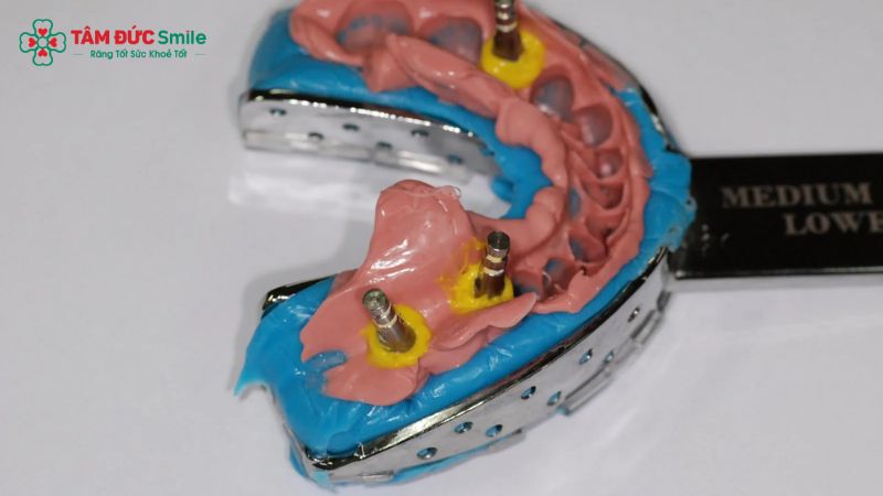 dung-cu-cay-ghep-implant-5