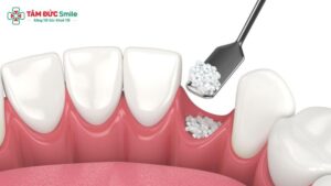 ghep-xuong-rang-khi-cay-implant-1