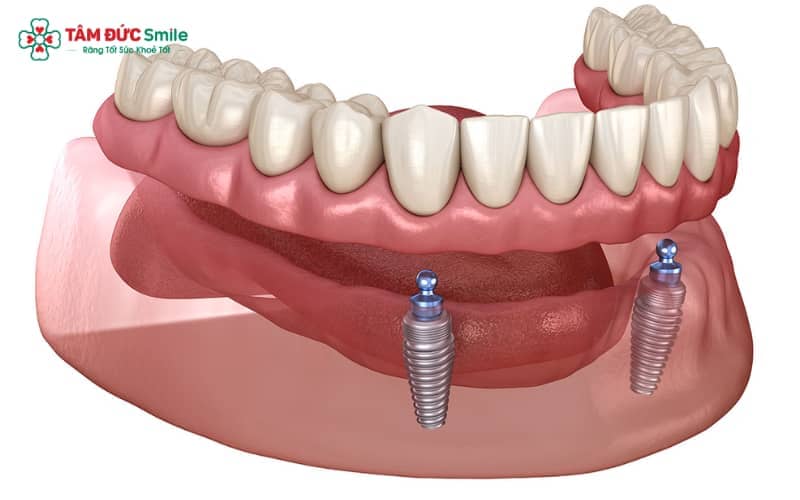 Hàm phủ trên Implant hoạt động như hàm tháo lắp, được ổn định bởi hệ thống chốt khóa liên kết với Implant