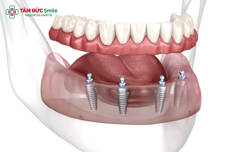 Hàm phủ Implant là hàm giả có thể tháo lắp, nhưng được nâng đỡ vững vàng nhờ các trụ Implant cố định trong xương