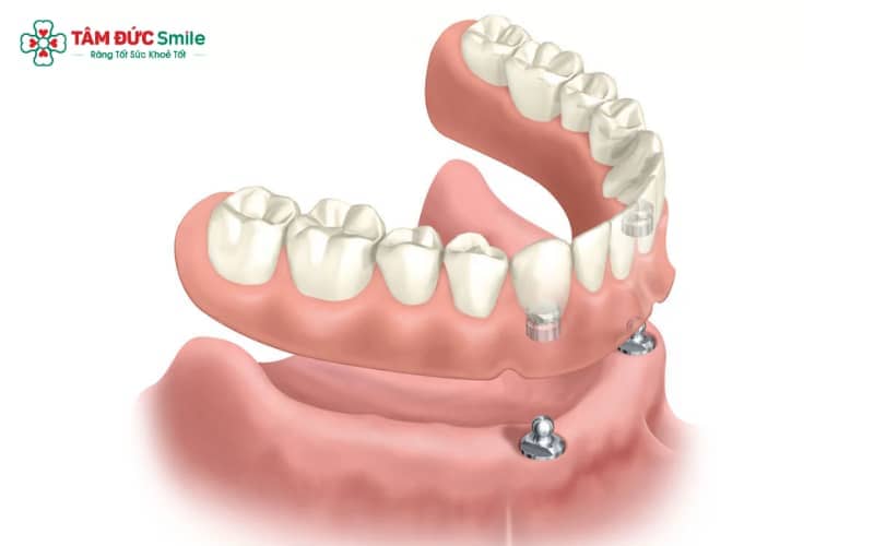 Hàm tháo lắp trên Implant là lựa chọn tối ưu, đáp ứng đồng thời nhu cầu tiện lợi, Abc8c1 com khuyến mãi hấp dẫn và hiệu quả ăn nhai