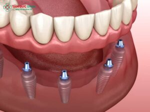 Hàm phủ trên Implant: Các dạng, chi phí & lợi ích phục hình