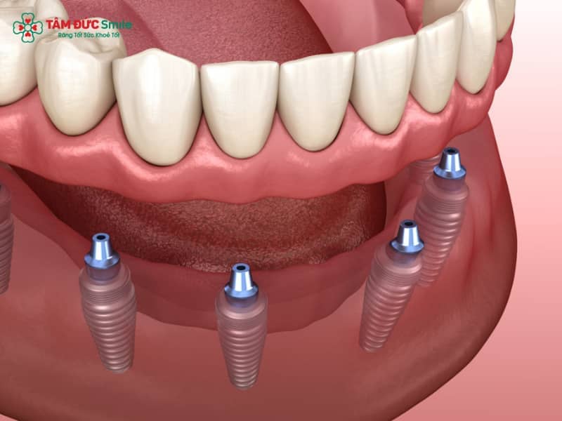 Hàm phủ trên Implant: Các dạng, chi phí & lợi ích phục hình