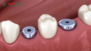 healing-abutment-1