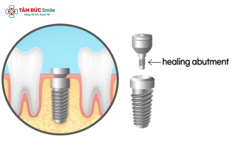 Healing trong Implant hỗ trợ quá trình hồi phục, đồng thời định hình mô nướu quanh trụ Implant