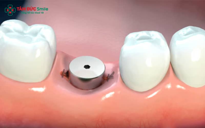 Healing Abutment được sử dụng ở giai đoạn nướu hồi phục, đảm bảo mô mềm quanh Implant ổn định