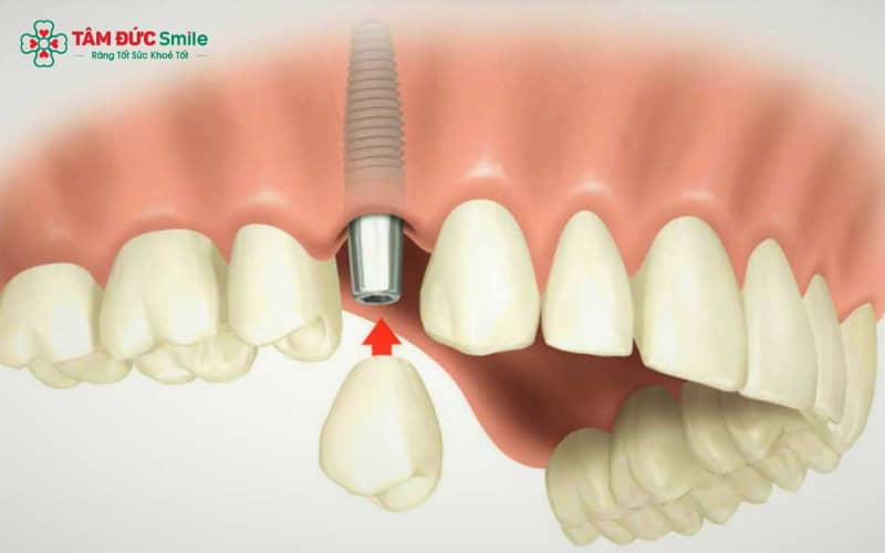 Healing Abutment tạo điều kiện cho lợi ôm khít, tái tạo viền nướu hài hòa