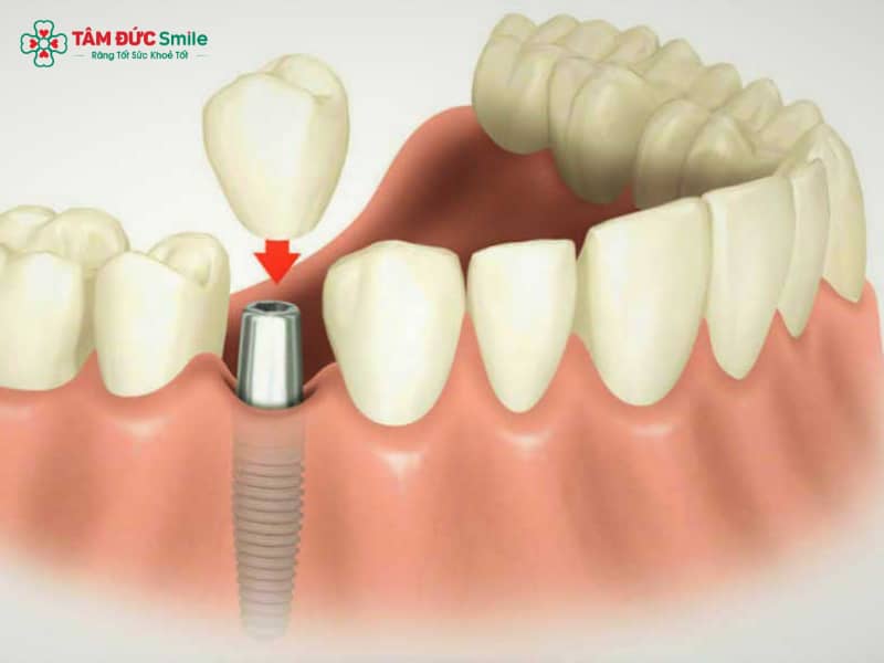 Healing trong Implant là gì? Vai trò, chất liệu, thời gian sử dụng