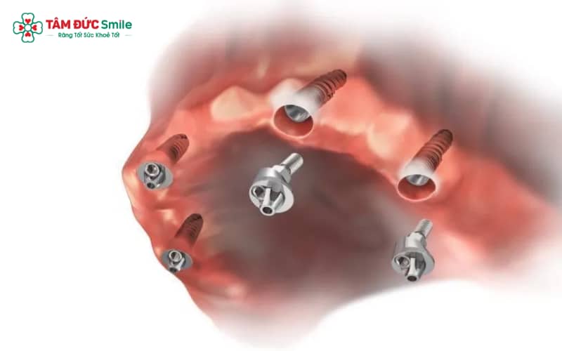 Implant Multi được ứng dụng trong phục hình răng, giúp khôi phục chức năng ăn nhai và Abc8c1 com khuyến mãi hấp dẫn