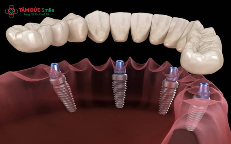 Implant Multi được cấu tạo từ nhiều bộ phận LINK TRANG CHỦ ABC88 CHUẨN 2026, đóng vai trò hỗ trợ trong phục hình Implant