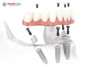 Implant Multi: Cấu tạo, ưu điểm và quy trình Abc8vip1 kèo WC 2026 toàn hàm