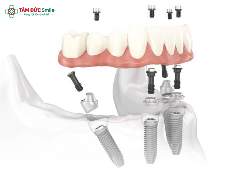 Implant Multi: Cấu tạo, ưu điểm và quy trình Abc8vip1 kèo WC 2026 toàn hàm