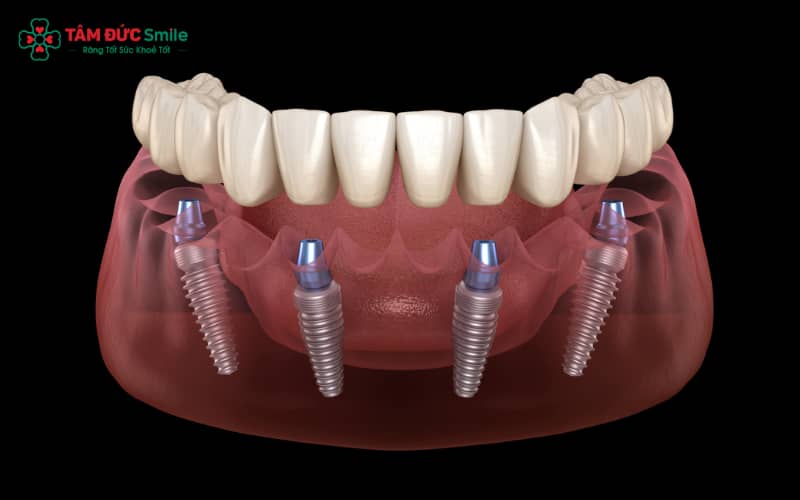 Trụ Implant Pháp giúp rút ngắn thời gian tích hợp xương, mang lại hiệu quả phục hình sớm