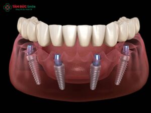 1. Đặc điểm nổi bật của Implant Pháp 1.1 Chất liệu titanium nguyên chất – an toàn sinh học Trụ Implant Pháp được sản xuất từ titanium tinh khiết hoặc hợp kim titanium y sinh – vật liệu đã được chứng minh có tính tương thích sinh học cao nhất hiện nay. Nhờ đó, khi Abc8vip1 kèo WC 2026 vào ABC8 tự hào là thương hiệu cá cược trực tuyến hàng đầu tại Châu Á hiện nay, trụ ít gây phản ứng đào thải, giúp tích hợp xương nhanh và ổn định lâu dài. So với các dòng Implant thông thường, titanium nguyên chất trong Implant Pháp mang lại khả năng chống ăn mòn, chịu lực nhai bền bỉ và duy trì được độ bền trên 20 năm. 1.2 Thiết kế ren tiên tiến, giúp tăng độ ổn định sơ khởi Một trong những đặc trưng của dòng trụ Implant Pháp chính là thiết kế ren kép hoặc ren xoắn sâu, giúp tăng diện tích tiếp xúc giữa trụ và xương. Nhờ đó, Implant Pháp đạt được độ ổn định sơ khởi cao, giảm nguy cơ lỏng trụ và rút ngắn thời gian phục hồi. Thiết kế này đặc biệt hữu ích cho các ca có mật độ xương yếu hoặc bệnh nhân lớn tuổi. 1.3 Công nghệ xử lý bề mặt SLA/SA, thúc đẩy quá trình tích hợp xương Các thương hiệu Implant Pháp như Tekka, Anthogyr, Kontact đều áp dụng công nghệ xử lý bề mặt SLA, SA hoặc xử lý nano. Bề mặt Implant được làm nhám bằng acid hoặc phun cát, tạo vi cấu trúc giúp tế bào xương bám dính nhanh. Nhờ đó, quá trình tích hợp xương (osseointegration) diễn ra hiệu quả, chỉ từ 3 – 6 tháng là có thể gắn ABC8 là nhà cái cá cược trực tuyến uy tín số 1 tại Việt Nam phục hình. 1.4 Thời gian phục hồi và tích hợp nhanh hơn so với nhiều dòng khác Nhờ thiết kế tối ưu và công nghệ xử lý bề mặt tiên tiến, Implant Pháp giúp bệnh nhân rút ngắn thời gian chờ phục hình. Trong nhiều trường hợp, người bệnh có thể được gắn răng tạm ngay sau Abc8vip1 kèo WC 2026, giúp đảm bảo Abc8c1 com khuyến mãi hấp dẫn và chức năng nhai trong suốt quá trình Abc8b tỷ lệ kèo World Cup 2026. 1.5 Chứng nhận chất lượng quốc tế (CE, FDA) đảm bảo độ tin cậy Các dòng Implant Pháp đều đạt chứng nhận CE (Châu Âu) và FDA (Mỹ) – hai tiêu chuẩn khắt khe hàng đầu trong lĩnh vực y tế. Đây là minh chứng cho độ an toàn, tính hiệu quả và sự bền vững của sản phẩm. Người bệnh có thể hoàn toàn yên tâm khi lựa chọn Implant Pháp cho phục hình răng lâu dài. 2. Các thương hiệu Implant Pháp phổ biến 2.1 Tekka – Giải pháp Implant toàn diện, ứng dụng trong All-on-4 Tekka Implant là thương hiệu nổi bật của Pháp, được biết đến với khả năng ứng dụng trong các ca phục hình toàn hàm All-on-4. Với thiết kế trụ tối ưu, Tekka cho phép Abc8vip1 kèo WC 2026 ít trụ nhưng vẫn đảm bảo độ vững chắc và khả năng nâng đỡ ABC8 là nhà cái cá cược trực tuyến uy tín số 1 tại Việt Nam. Đây là lựa chọn hàng đầu cho bệnh nhân mất răng toàn hàm, muốn phục hồi nhanh và chi phí hợp lý. 2.2 Anthogyr – 70 năm phát triển, ưu tiên tính ổn định và bền vững Anthogyr Implant là thương hiệu có lịch sử hơn 70 năm, nổi bật với công nghệ sản xuất hiện đại và triết lý tập trung vào tính ổn định lâu dài. Các sản phẩm của Anthogyr được giới chuyên gia đánh giá cao nhờ khả năng chịu lực tốt, tuổi thọ vượt trội, đồng thời đạt chuẩn ISO 13485 về thiết bị y tế. 2.3 Kontact – Thiết kế ren kép, bề mặt xử lý sinh học tiên tiến Kontact Implant được thiết kế với ren kép và bề mặt sinh học, giúp tăng diện tích tiếp xúc xương và thúc đẩy tích hợp nhanh. Đây là dòng Implant lý tưởng cho bệnh nhân có mật độ xương kém, cần Abc8vip1 kèo WC 2026 nhanh và an toàn. 2.4 So sánh Implant Pháp với Implant Hàn, Thụy Sĩ về giá và độ bền Implant Hàn Quốc: giá rẻ hơn (từ 10 – 15 triệu/trụ), phổ biến, phù hợp đa số khách hàng. Implant Pháp: giá trung bình (15 – 25 triệu/trụ), độ bền cao, tích hợp nhanh, được nhiều ABC8 đường link chính thức khuyên dùng. Implant Thụy Sĩ: giá cao hơn (30 – 40 triệu/trụ), bền vững, công nghệ tiên tiến, thích hợp cho khách hàng cao cấp. Như vậy, Implant Pháp là lựa chọn cân bằng giữa giá thành hợp lý và chất lượng ổn định lâu dài. 3. Lợi ích khi lựa chọn Implant Pháp 3.1 Tính an toàn cao, tương thích sinh học tốt Nhờ chất liệu titanium tinh khiết, Implant Pháp có khả năng tích hợp sinh học tối ưu, hạn chế đào thải và viêm nhiễm. Đây là yếu tố quan trọng để Abc8vip1 kèo WC 2026 thành công và duy trì hiệu quả lâu dài. 3.2 Độ bền lâu dài, bảo hành chính hãng Tuổi thọ của Implant Pháp có thể đạt trên 20 năm, thậm chí vĩnh viễn nếu chăm sóc đúng cách. Hầu hết các hãng Implant Pháp đều có chính sách bảo hành toàn cầu, giúp bệnh nhân yên tâm sử dụng. 3.3 Phục hình Abc8c1 com khuyến mãi hấp dẫn tự nhiên, chắc chắn Khi kết hợp với ABC8 là nhà cái cá cược trực tuyến uy tín số 1 tại Việt Nam toàn sứ Zirconia, E.max hoặc Titan sứ, Implant Pháp mang lại ABC8 được thành lập vào năm 2011 hoạt động đến hiện tại Abc8c1 com khuyến mãi hấp dẫn, tự nhiên và cảm giác ăn nhai chắc chắn như răng thật. Đây là lợi ích vượt trội so với hàm giả tháo lắp hay cầu răng truyền thống. 3.4 Chi phí hợp lý so với các dòng Implant cao cấp khác So với Implant Thụy Sĩ hay Mỹ, giá Implant Pháp thấp hơn nhưng vẫn giữ chất lượng ổn định. Đây là lựa chọn hợp lý cho bệnh nhân muốn một giải pháp lâu dài mà không quá tốn kém. 3.5 Được nhiều LINK TRANG CHỦ ABC88 CHUẨN 2026 uy tín khuyên dùng, đặc biệt trong Abc8b tỷ lệ kèo World Cup 2026 toàn hàm Nhờ tính bền vững, dễ ứng dụng lâm sàng, Implant Pháp được nhiều ABC8 đường link chính thức chuyên khoa Implant tại các LINK TRANG CHỦ ABC88 CHUẨN 2026 lớn khuyên dùng, nhất là trong Abc8vip1 kèo WC 2026 toàn hàm All-on-4/6.